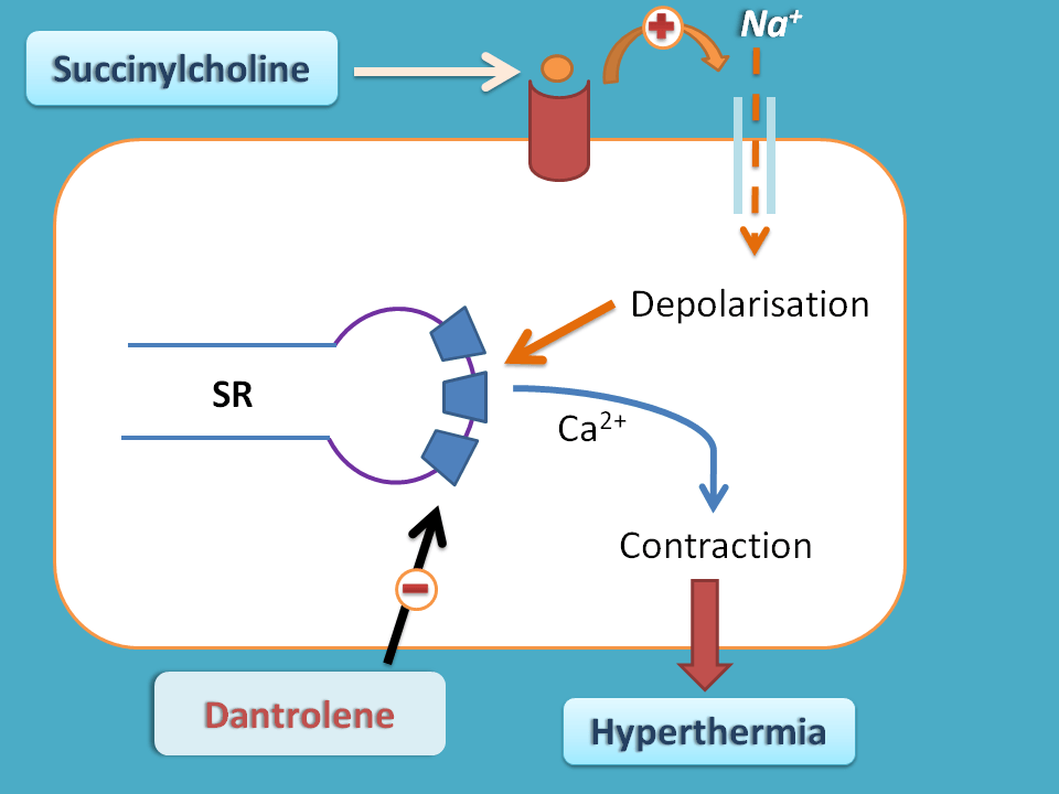 succinylcholine induced malignant hyperthermia