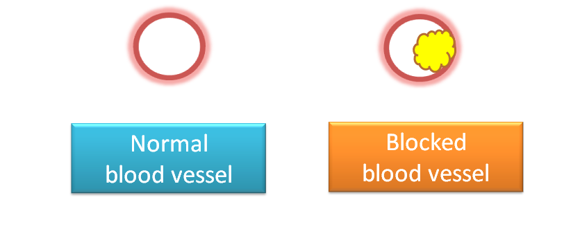 Blocking of blood vessel by formation of atheroma